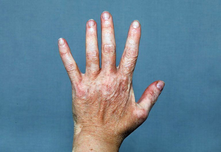Weißfleckenkrankheit Vitiligo